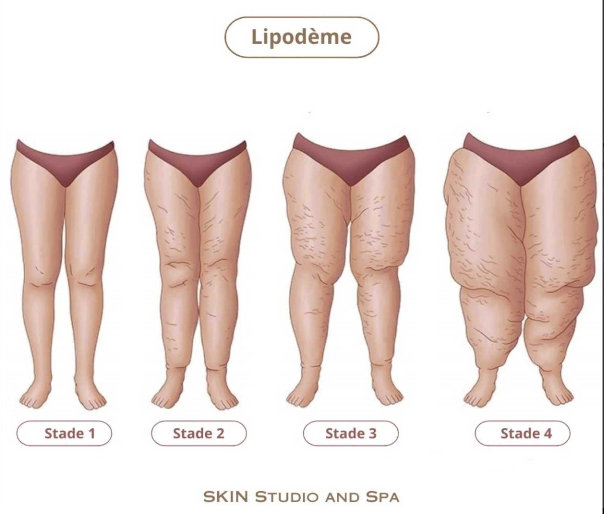 Avant/Après lipoaspiration lipoedeme